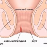 анальная трещина