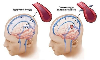 Ангиоспазм сосудов головного мозга