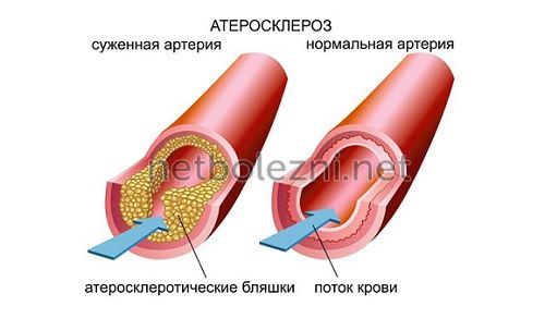 Артерии при атеросклерозе