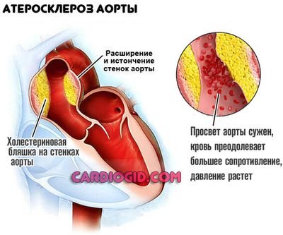 атеросклероз-аорты