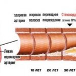 атеросклероз артерий
