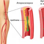 Атеросклероз артерий ног