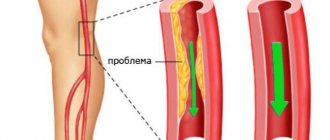 Атеросклероз артерий ног