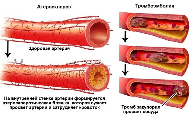 Атеросклероз и Тромбоэмболия