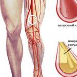 Атеросклероз сосудов ног