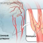 Бляшки в сонных артериях являются самой частой причиной ишемического инсульта