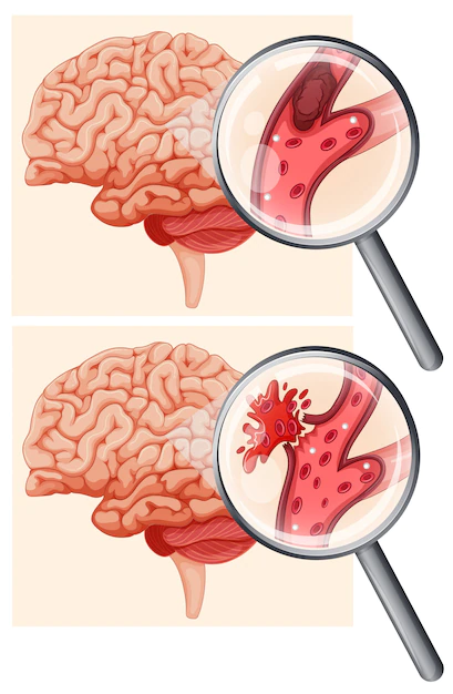 Человеческий мозг и геморрагический инсульт | Премиум векторы