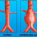 Что такое аневризма аорты