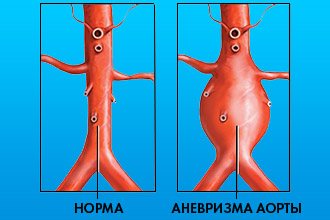 Что такое аневризма аорты