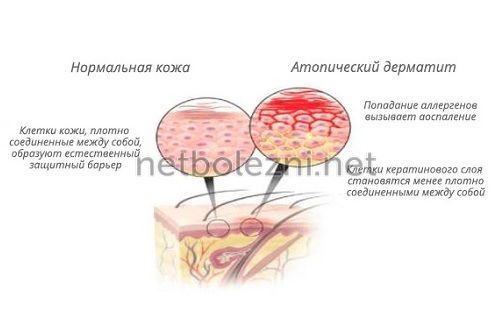 Что такое атопический дерматит