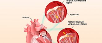 Дефект митрального клапана