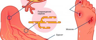 Диабетическая ангиопатия нижних конечностей