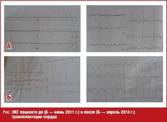 ЭКГ пациента до (А — июнь 2011 г.) и после (Б — апрель 2014 г.) трансплантации сердца