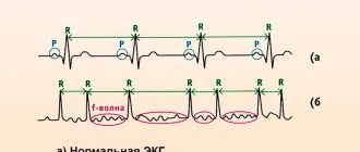 ЭКГ-признаки аритмии