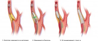 Этапы установки стента