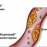 фракции холестерина в артерии