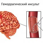 Геморрагический инсульт