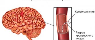 Геморрагический инсульт