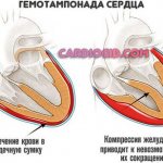 гемотампонада-сердца