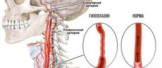 Гипоплазия-позвоночной-артерии