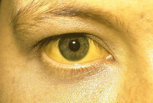 Глаза при желтухе