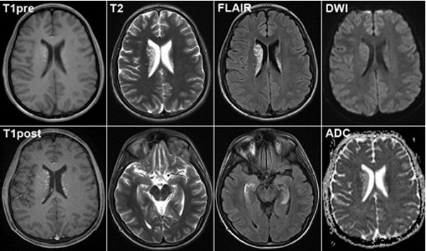 Головной мозг на МРТ при разных режимах сканирования
