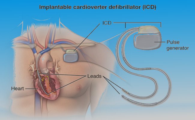 Имплантируемый кардиовертер-дефибриллятор