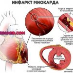 инфаркт-миокарда