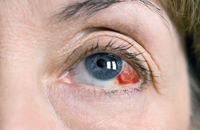 Инсульт глаза симптомы ⋆ Лечение Сердца