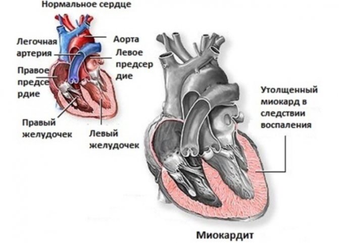 Изменение мышечной структуры сердца