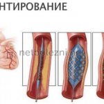 Как происходит стентирование