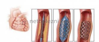 Как происходит стентирование