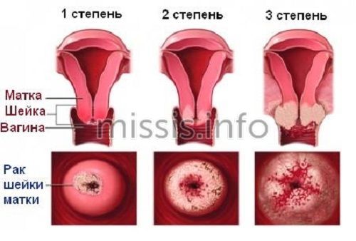 Как развивается рак шейки матки