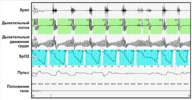 Кардиореспираторное мониторирование дает возможность выявить эпизоды апноэ и нарушений ритма