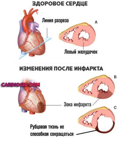 кардиосклероз-после-инфаркта