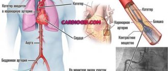 коронарография-сосудов-сердца