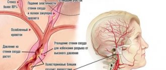 Кровоизлияние в мозг: причины и лечение, признаки острой стадии и симптомы-предшественники, последствия и прогноз