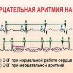 Мерцательная аритмия на ЭКГ