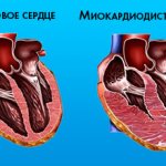 Миокардиодистрофия