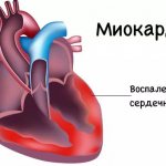 Миокардит