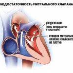 Митральная недостаточность 2.jpg