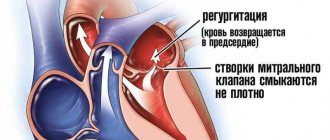 Митральная недостаточность 2.jpg