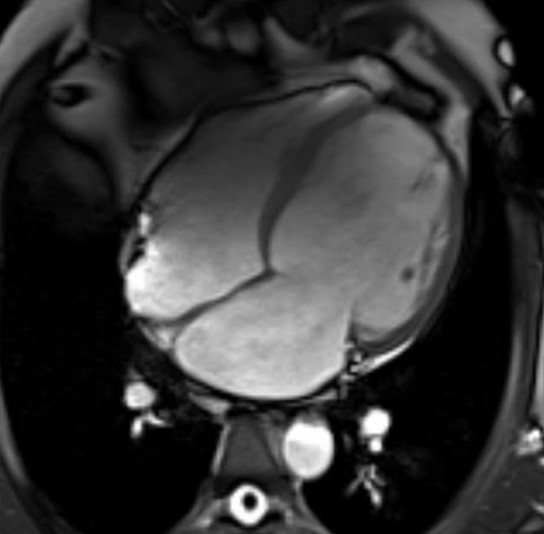 МР-снимок сердца показывает увеличение камер
