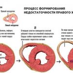 недостаточность правого желудочка