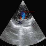 Некомпактный миокард или гипертрабекулярность левого желудочка/NONCOMPACTION CARDIOMYOPATHY OR LEFT VENTRICULAR HYPERTRABECULARITY