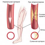 Облитерирующий атеросклероз артерий нижних конечностей 2.jpg