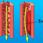 Образование тромба
