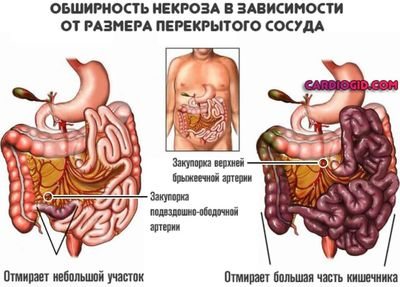 Обширность некроза кишечника в зависимости от места эмбола