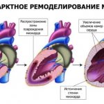 оценка жизни способности миокарда