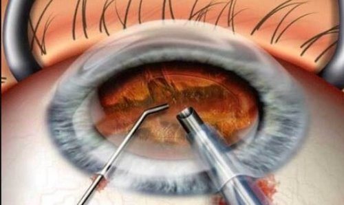 Операция по удалению глаукомы